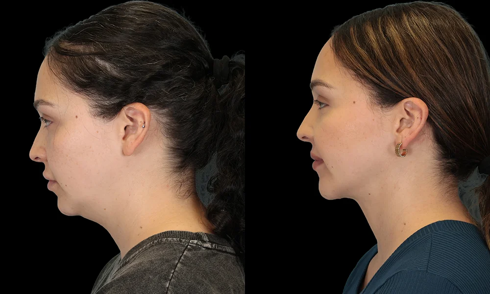 Real patient results in New York, NY Performed by Sameer Halani, MD