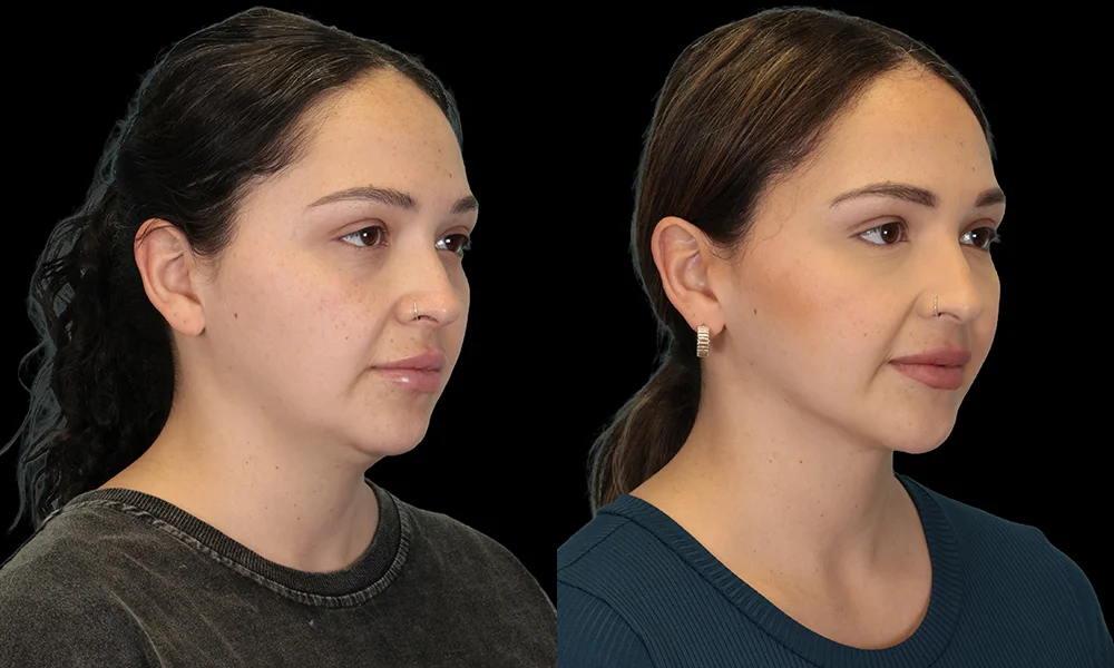 Real patient results in New York, NY Performed by Sameer Halani, MD