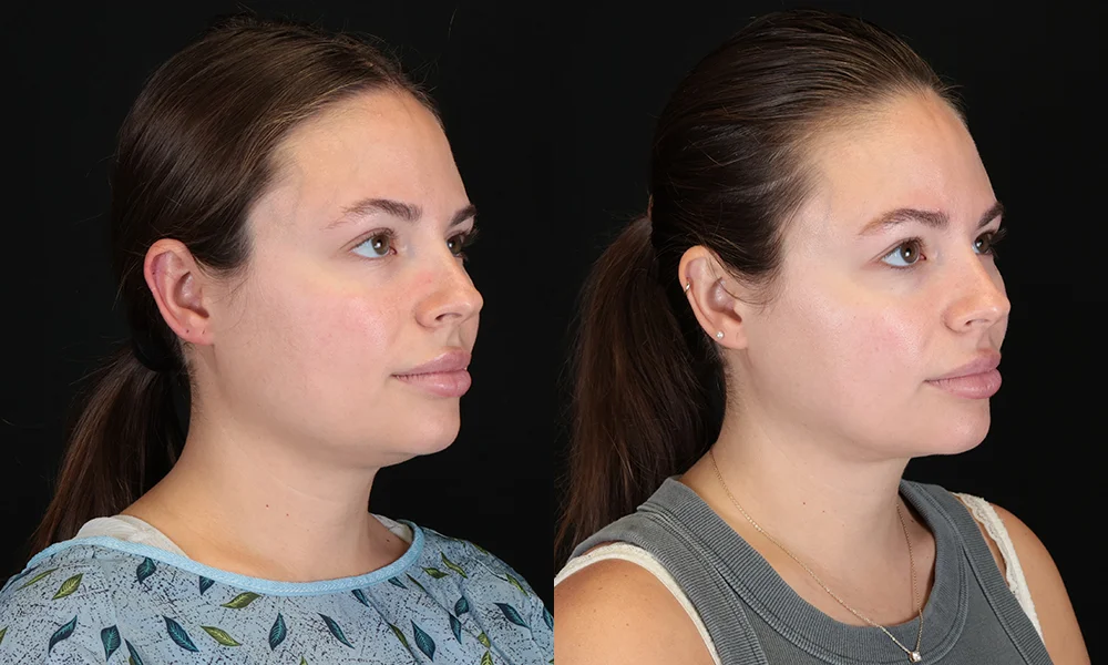 Real patient results in New York, NY Performed by Sameer Halani, MD