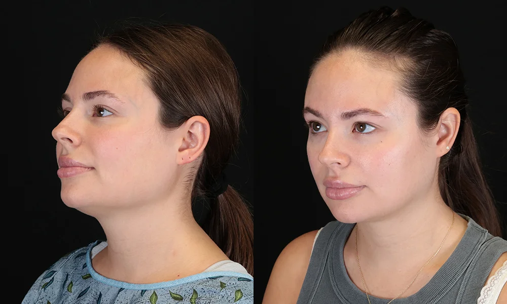 Real patient results in New York, NY Performed by Sameer Halani, MD
