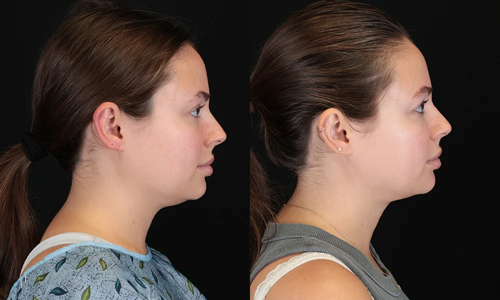 Real patient results in New York, NY Performed by Sameer Halani, MD