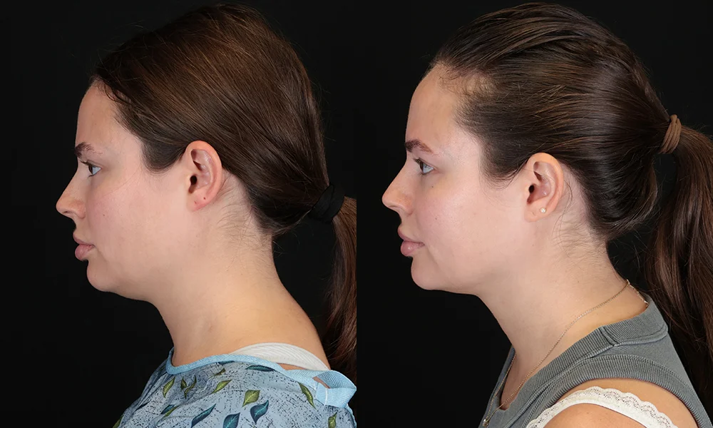 Real patient results in New York, NY Performed by Sameer Halani, MD