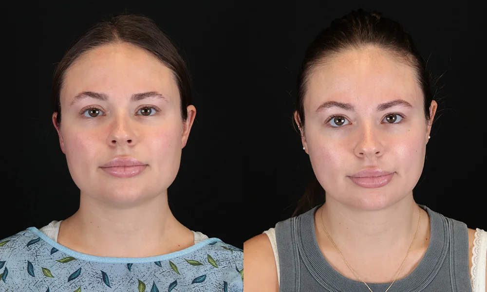 Real patient results in New York, NY Performed by Sameer Halani, MD