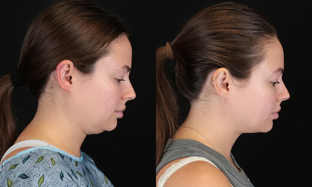 Real patient results in New York, NY Performed by Sameer Halani, MD