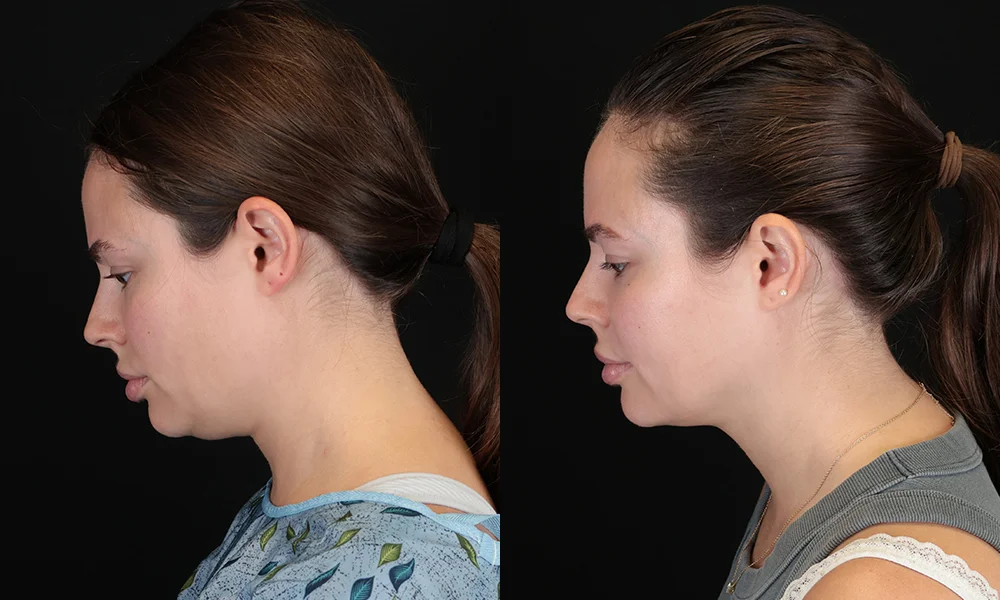 Real patient results in New York, NY Performed by Sameer Halani, MD
